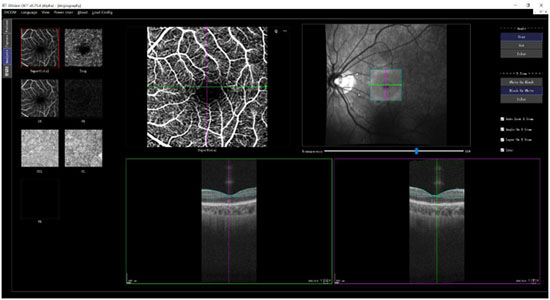 眼科光学相干断层扫描仪临床试验图4