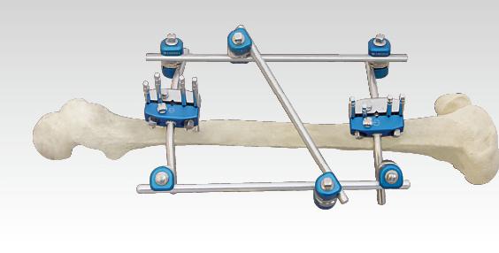 骨科外固定支架