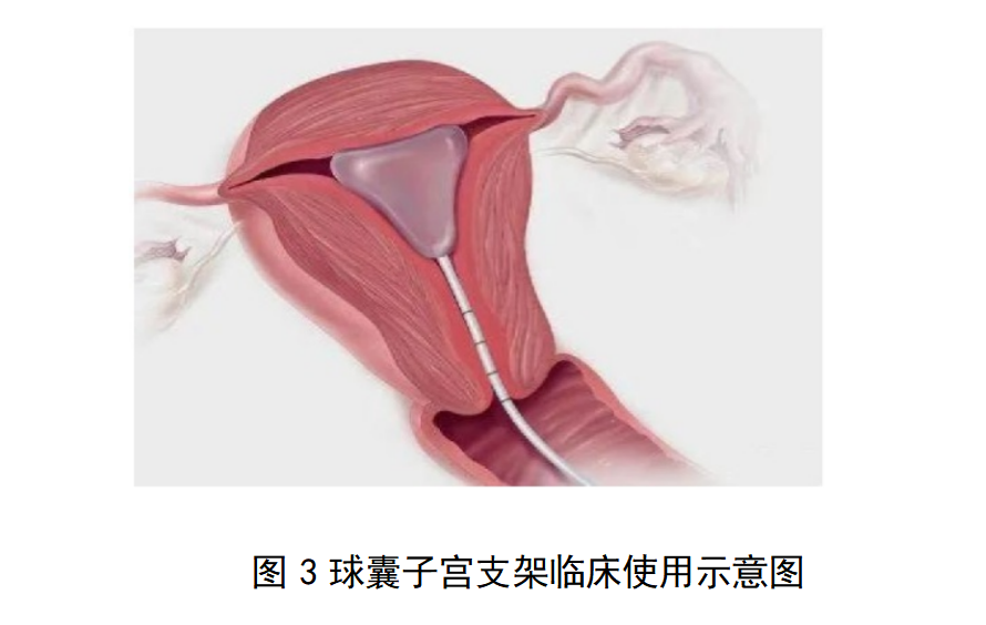 一次性使用球囊子宫支架审评要点(征求意见稿)(图4)