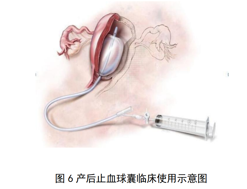 一次性使用球囊子宫支架审评要点(征求意见稿)(图7)